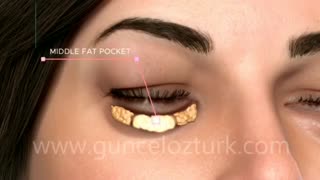 انیمیشن بلفاروپلاستی