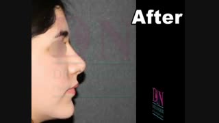 نمونه جراحی بینی توسط دکتر داریوش نادری