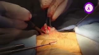 فیلم جراحی ژنیکوماستی