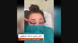 فیلم جراحی لیفت ابرو و تزریق چربی به صورت