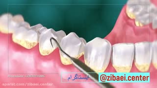 جرم گیری دندان یا بروساژ دندان - زیبایی سنتر