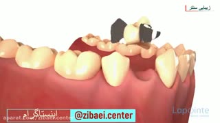 بریج دندان یا پل دندان - دندان مصنوعی - زیبایی سنتر