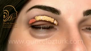 بلفاروپلاستی برای چه کسانی توصیه می شود