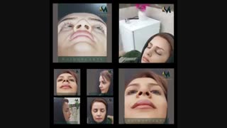 دو هفته بعد از جراحی بینی
