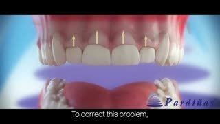 خنده لثه ای را با لیزر درمان کنید