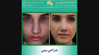 جراحی بینی توسط دکتر عبدالرضا روئین تن فوق تخصص جراحی پلاستیک