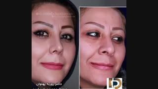 فیلم کامل جراحی زیبایی بینی