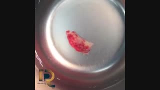 ایمپلینت و پیوند استخوان