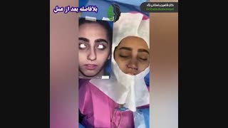 جراحی بینی با پوست نازک و قاعده پهن | دکتر باستانی نژاد