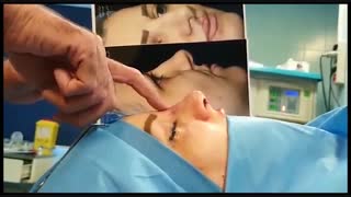 اصلاح انحراف بینی غضروفی توسط دکتر ابراهیمی جراح بینی تهران