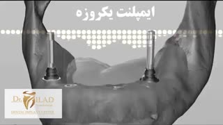ایمپلنت یک روزه دندان