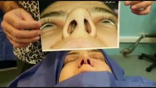 عمل زیبایی بینی گوشتی | دکتر امید ابراهیمی بهترین جراح بینی تهران