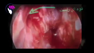 ترمیم نشت مایع مغزی نخاعی بیمار مبتلا به کرونا