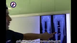 تعویض مفصل مجدد به دلیل شل شدن استم فمور