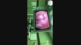 لاپاراسکوپی میوکتومی