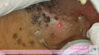 درمان قطعی زگیل تناسلی مردان با لیزر |  دکتر عباس انتظاری