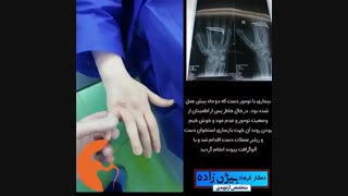 عمل تومور دست