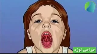 انیمیشن جراحی لوزه