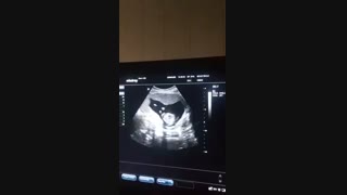 آزمایش امنیوسنتز