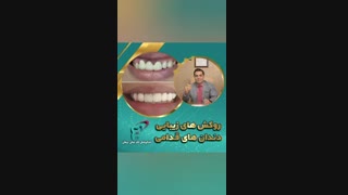 روکش های زیبایی دندان های قدامی