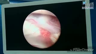 فیلم جراحی هیدروسفالی و جراحی آندوسکوپی توسط دکتر گیو شریفی