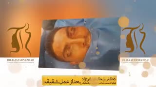 فیلم لیفت شقیقه