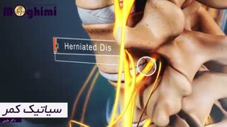 انیمیشن درباره سیاتیک کمر
