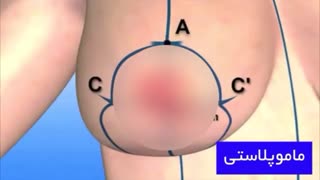 انیمیشن ماموپلاستی