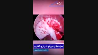 عمل تنگی مجرای ادراری آقایان