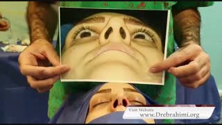 جراحی بینی استخوانی توسط دکتر امید ابراهیمی بهترین جراح بینی