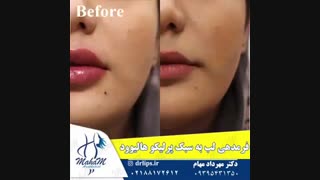 ژل لب