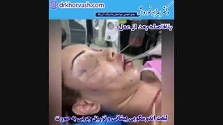 فیلم لیفت پیشانی و تزریق چربی به صورت