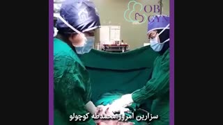 فیلم عمل جراحی سزارین