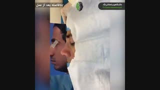 جراحی بینی اولیه در بیمار با فرم بینی ایرانی | جراحی زیبایی بینی توسط دکتر باستانی نژاد