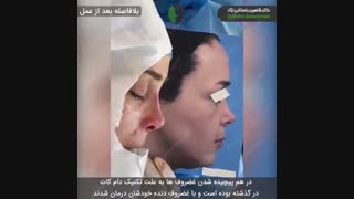 جراحی بینی ترمیمی بسیار مشکل | دکتر باستانی نژاد | جراح بینی تهران