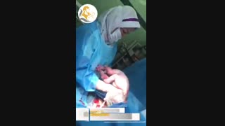 سزارین همراه با خارج کردن فیبروم