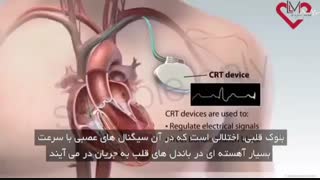 دستگاه ضربان ساز (CRT)