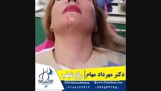 رفع غبغب بدون جراحی