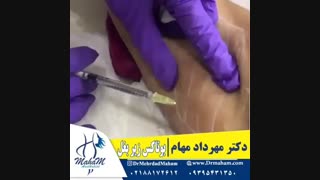 بوتاکس زیر بغل