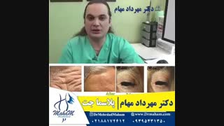 درمان افتادگی پلک