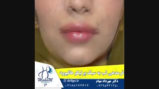 ژل لب