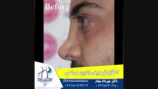 اصلاح فرم بینی بدون جراحی