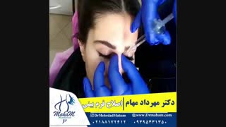 اصلاح فرم بینی بدون جراحی
