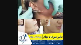 زاویه سازی صورت