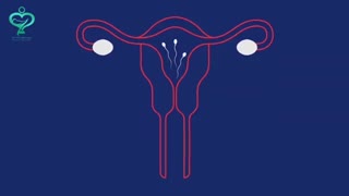 آی یو دی چیست؟