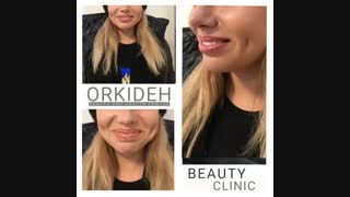 چال گونه  در کلینیک زیبایی