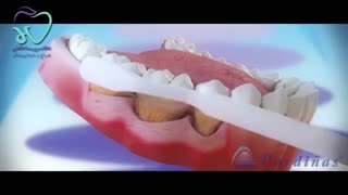 صحبتهای دکتر پریسا حافظی درباره بیماریهای پریودنتال
