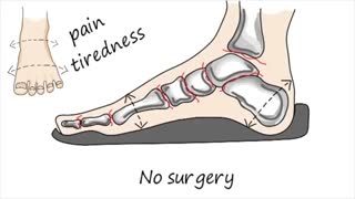 درمان کف پای صاف در کودکان بدون جراحی