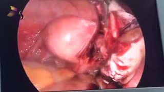 جراحی لاپاراسکوپی