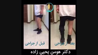 نتیجه عمل جراحی تعویض مفصل زانو